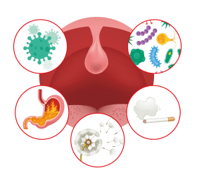 Cause del mal di gola